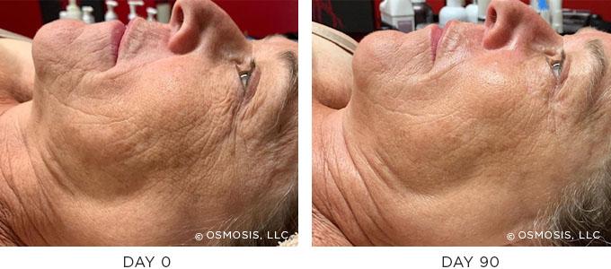 Osmosis Skincare Before After Aging