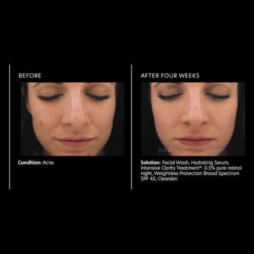 Intensive Clarity Treatment 0.5 pure retinol night Before After 2