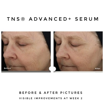 SkinMedica TNS Advanced Serum Before and After