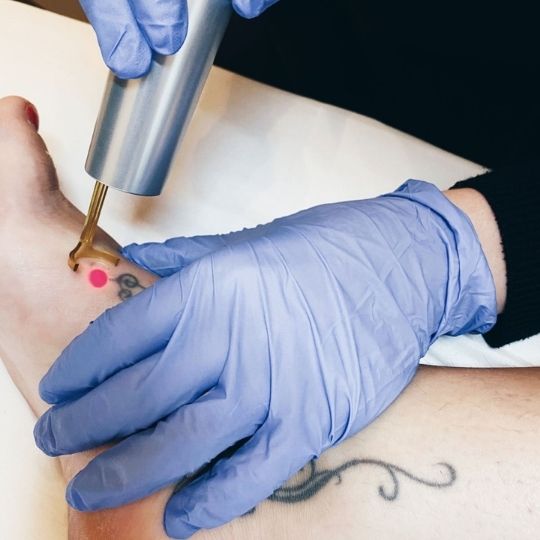 Tattoo Removal Moncton